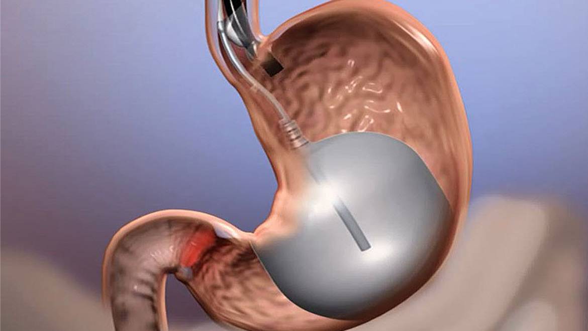 Infectious balloon for weight loss